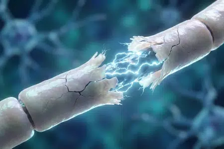 Macroscopic illustration of a human nerve fiber with a cracked myelin sheath and an electrical short circuit.