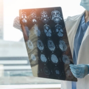 Treatment of Nerve Inflammation